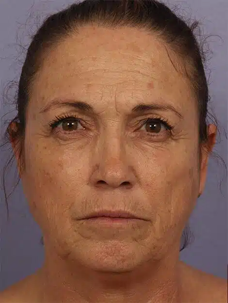 Dysport Cosmetic Treatment Before And After Results Showing Improved Skin Appearance.