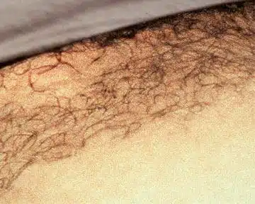 Before And After Results Of Laser Hair Removal Treatment