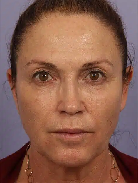 Dysport Cosmetic Treatment Before And After Results Showing Improved Skin Appearance.