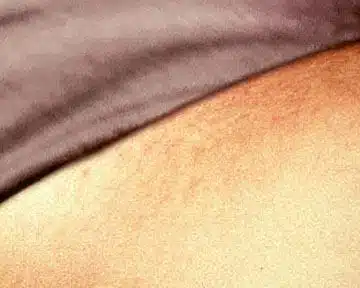 Before And After Results Of Laser Hair Removal Treatment