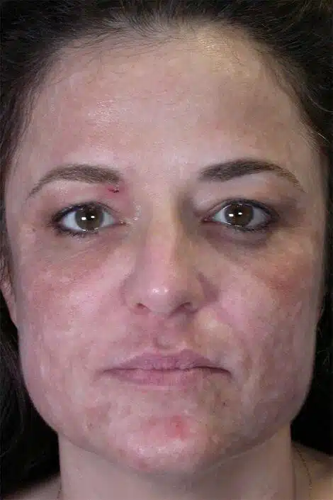 Dysport Cosmetic Treatment Before And After Results Showing Improved Skin Appearance.