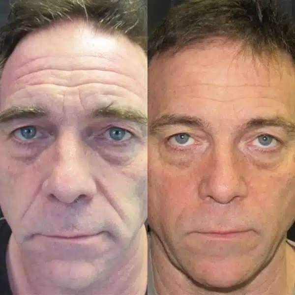 Before And After Images Showcasing Morpheus8 San Ramon Results On Different Skin Types, Demonstrating Improvements In Skin Texture, Fine Lines, And Sagging.