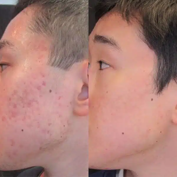 Before And After Images Showcasing Morpheus8 San Ramon Results On Different Skin Types, Demonstrating Improvements In Skin Texture, Fine Lines, And Sagging.