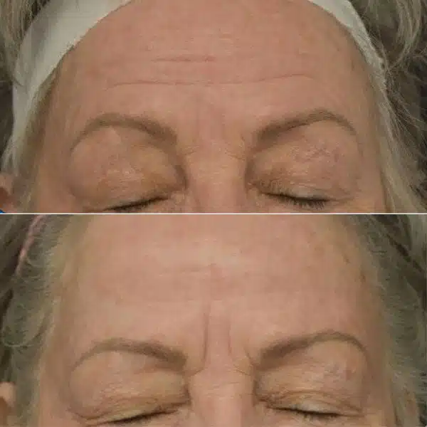 Before And After Images Showcasing Morpheus8 San Ramon Results On Different Skin Types, Demonstrating Improvements In Skin Texture, Fine Lines, And Sagging.