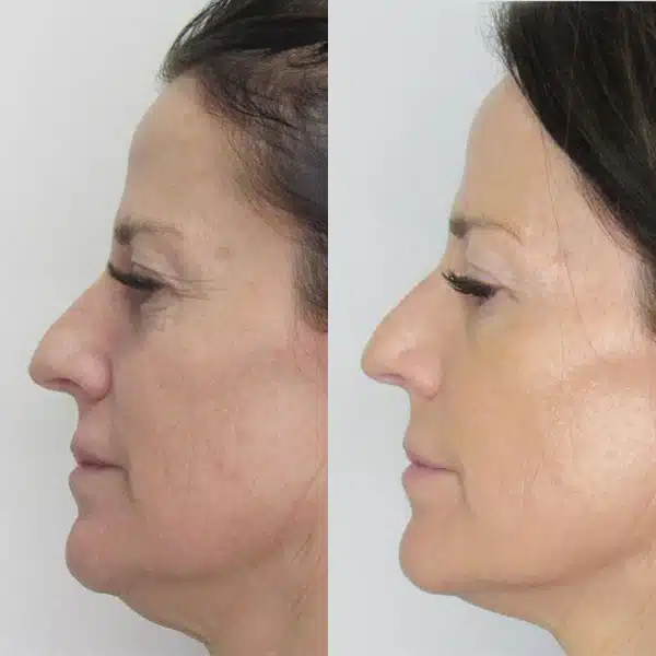 Before And After Images Showcasing Morpheus8 San Ramon Results On Different Skin Types, Demonstrating Improvements In Skin Texture, Fine Lines, And Sagging.