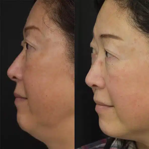 Before And After Images Showcasing Morpheus8 San Ramon Results On Different Skin Types, Demonstrating Improvements In Skin Texture, Fine Lines, And Sagging.