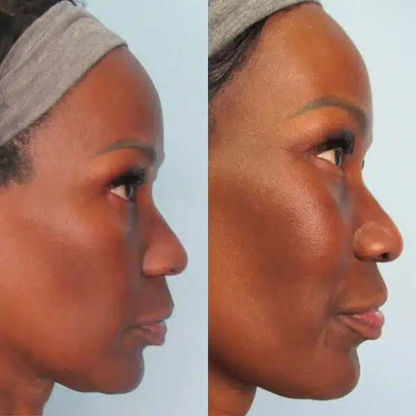 Before And After Images Showcasing Morpheus8 San Ramon Results On Different Skin Types, Demonstrating Improvements In Skin Texture, Fine Lines, And Sagging.