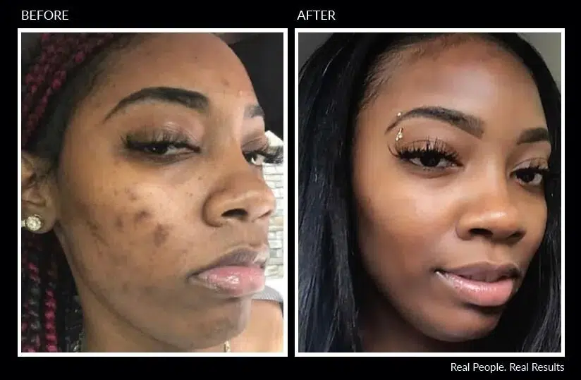 Before And After Results Of Chemical Peel Treatment Showing Improved Skin Texture And Clarity.