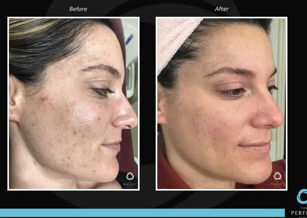 Before And After Results Of Chemical Peel Treatment Showing Improved Skin Texture And Clarity.