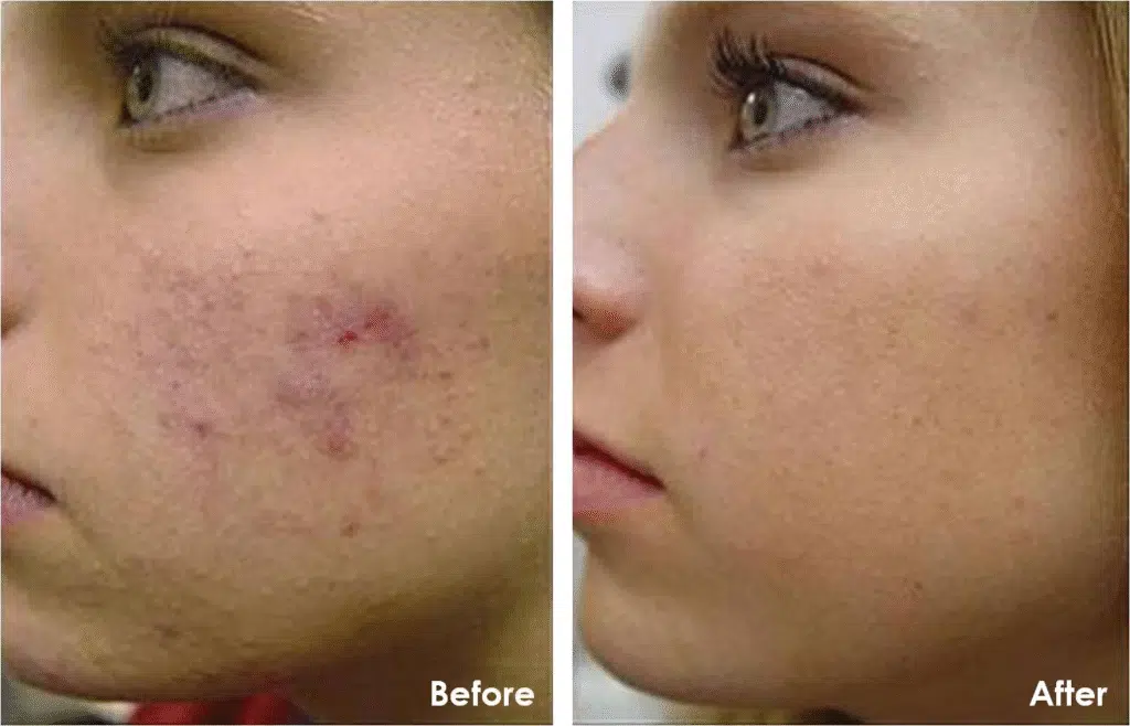 Before And After Results Of Chemical Peel Treatment Showing Improved Skin Texture And Clarity.
