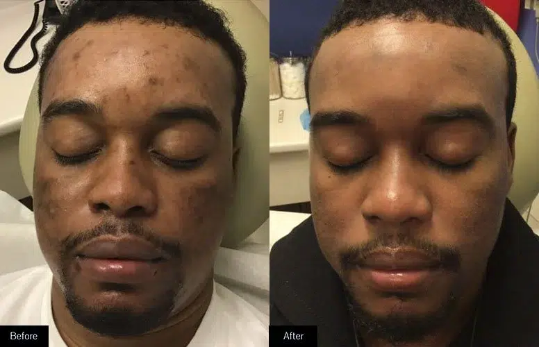 Before And After Results Of Chemical Peel Treatment Showing Improved Skin Texture And Clarity.