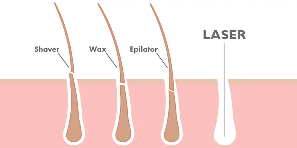 Illustration-comparing-hair-removal-methods-shaver-wax-epilator-and-laser-showing-different-depths-of-hair-removal.