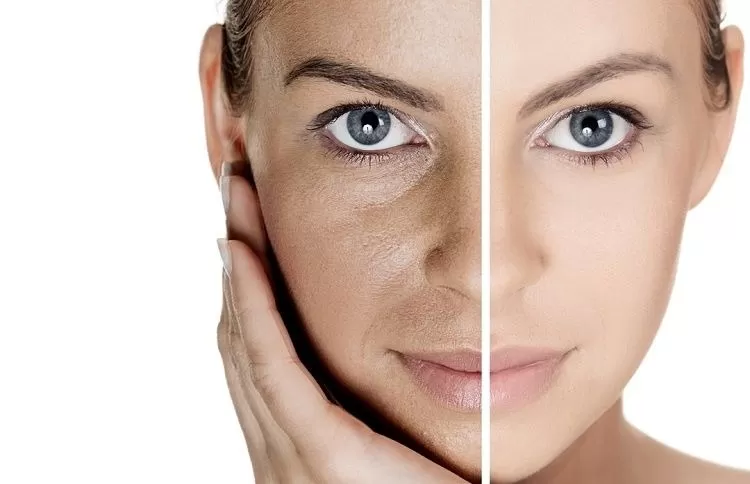 Before-and-after-photo-of-skin-treatment-showing-woman's-face-with-visible-skin-improvement-on-the-right.