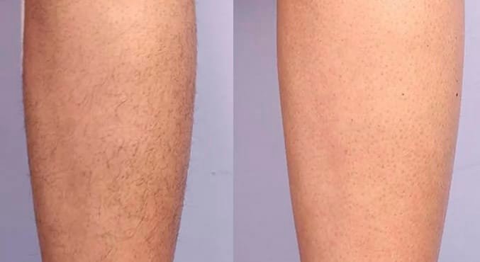 Before-and-after-comparison-of-leg-hair-removal-showing-areas-with-hair-on-the-left-and-smooth-skin-on-the-right.