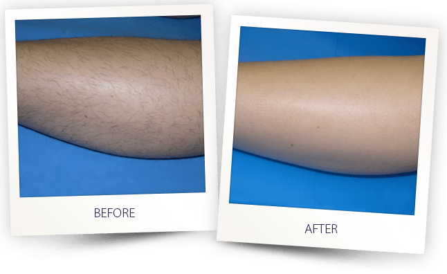 Before-and-after-photo-of-arm-hair-removal-showing-hairy-arm-on-the-left-and-smooth-skin-on-the-right.
