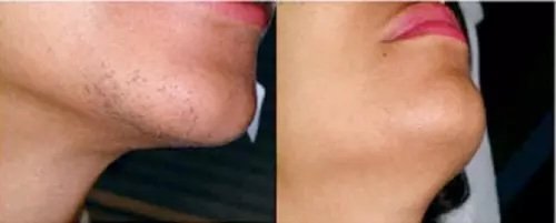 Before-and-after-photo-of-chin-hair-removal-showing-hair-covered-chin-on-the-left-and-smooth-skin-on-the-right.