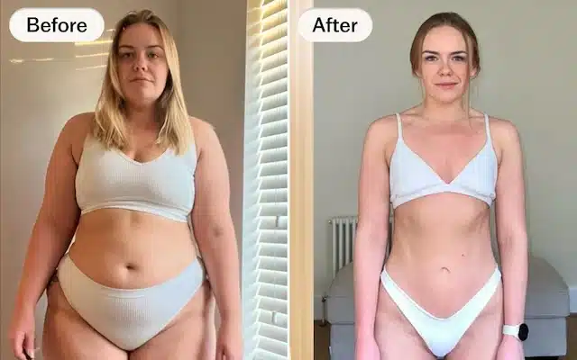 Beforeaftertirzepatide1