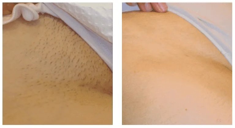 Before-and-after-photo-of-underarm-hair-removal-showing-hair-covered-underarm-on-the-left-and-smooth-skin-on-the-right.