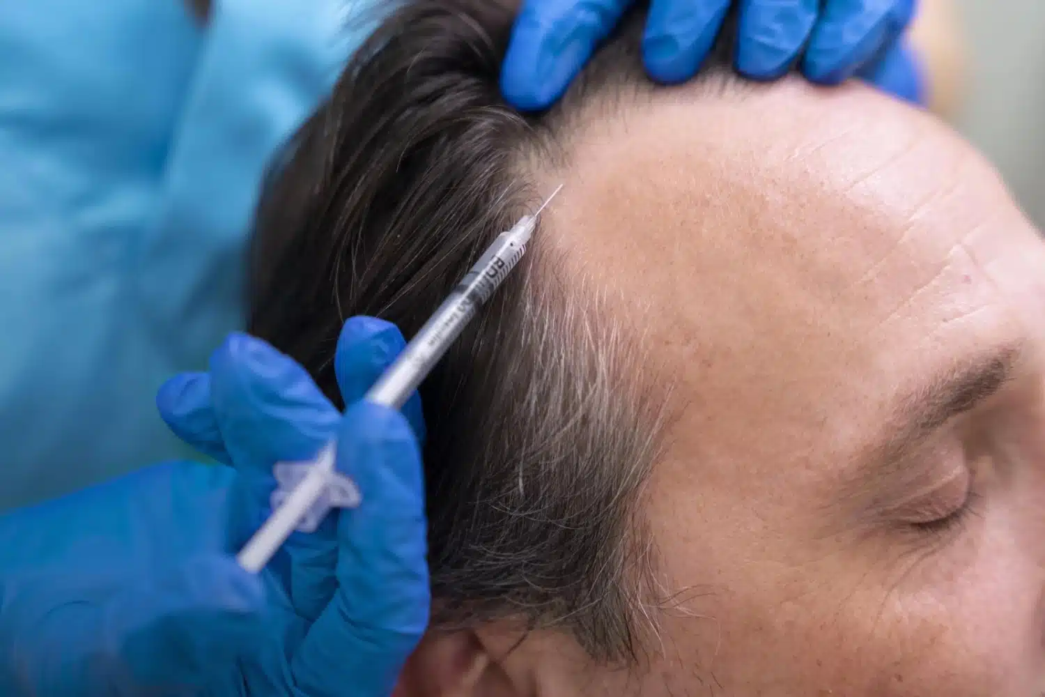Close-Up-Of-Prp-Injection-For-Hair-Loss-Treatment-At-Medlounges-San-Ramon