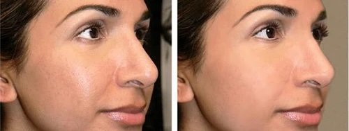 Before-and-after-photo-of-woman's-nose-showing-improvement-after-rhinoplasty-with-visible-changes-in-profile.