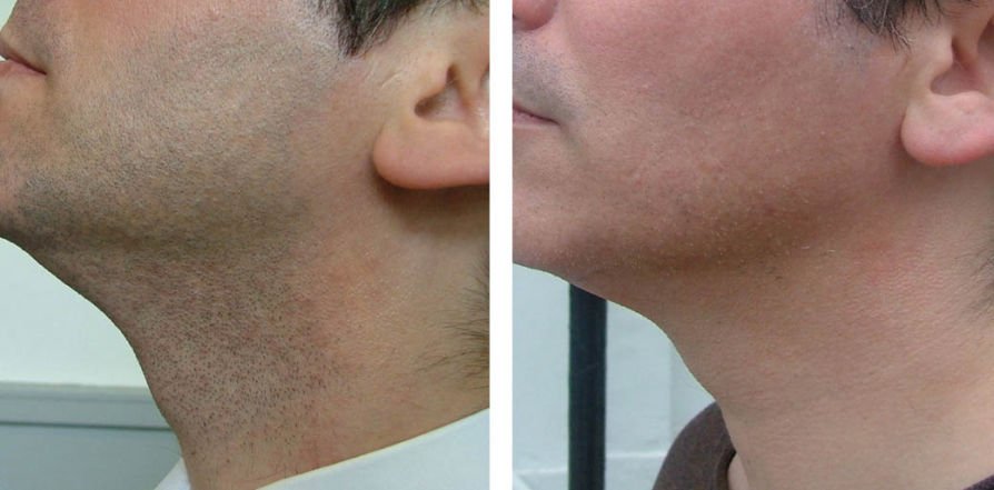 Before-and-after-photo-of-male-neck-hair-removal-showing-hair-covered-neck-on-the-left-and-smooth-skin-on-the-right