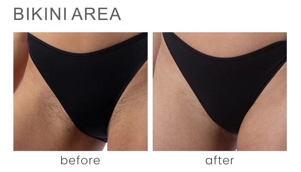 Before-and-after-photo-of-bikini-area-hair-removal-showing-hair-covered-area-on-the-left-and-smooth-skin-on-the-right.