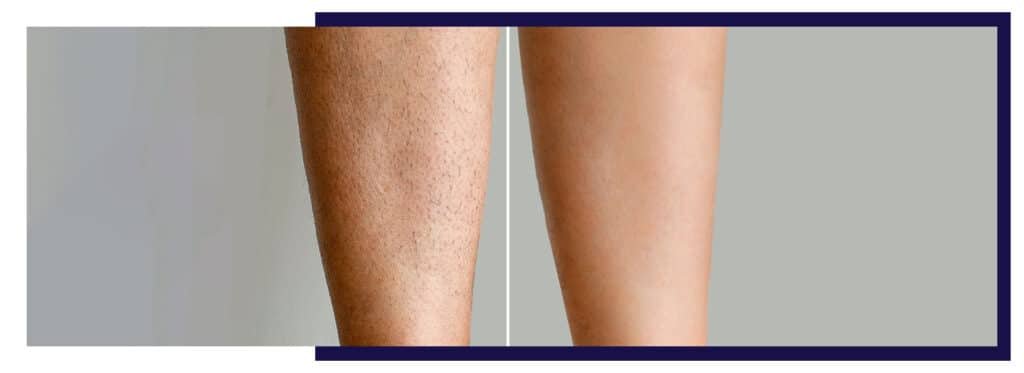 Before-and-after-comparison-of-leg-hair-removal-showing-hair-covered-leg-on-the-left-and-smooth-skin-on-the-right.