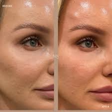 Before and after results of under-eye rejuvenation treatment showing smoother and refreshed skin.