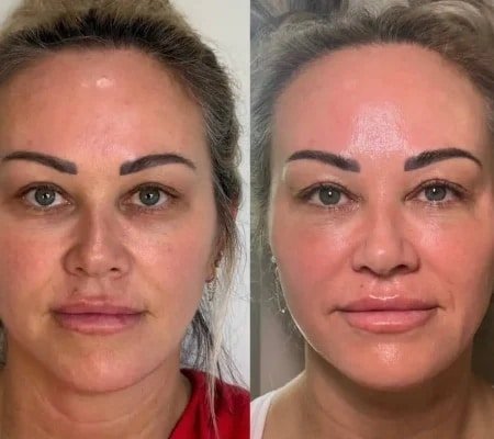 Before and after results of under-eye rejuvenation treatment showing smoother and refreshed skin.