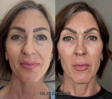 Before and after results of under-eye rejuvenation treatment showing smoother and refreshed skin.