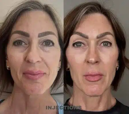 Pdgf Growth Factor Treatment For Crepey Under Eye Skin At Medlounge San Ramon Improving Skin Thickness And Collagen Density