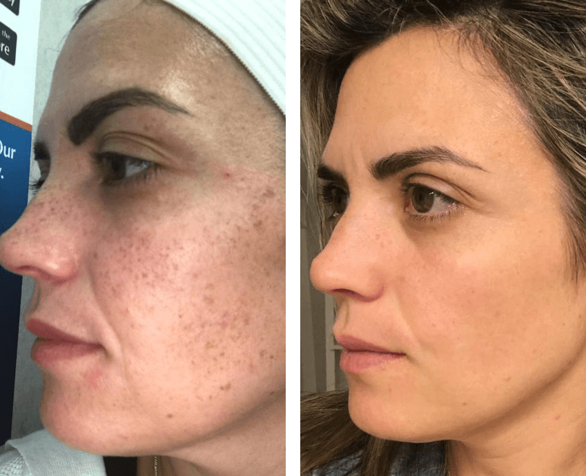 Before and after IPL photofacial for redness and rosacea using Lumecca IPL at MedLounge San Ramon