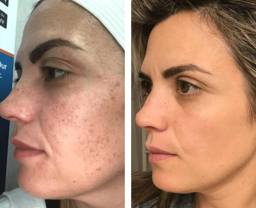 Hydrafacial In San Ramon Ca | Deep Cleansing &Amp; Glowing Skin – Medlounge 9 Before And After Ipl Photofacial For Redness And Rosacea Using Lumecca Ipl At Medlounge San Ramon