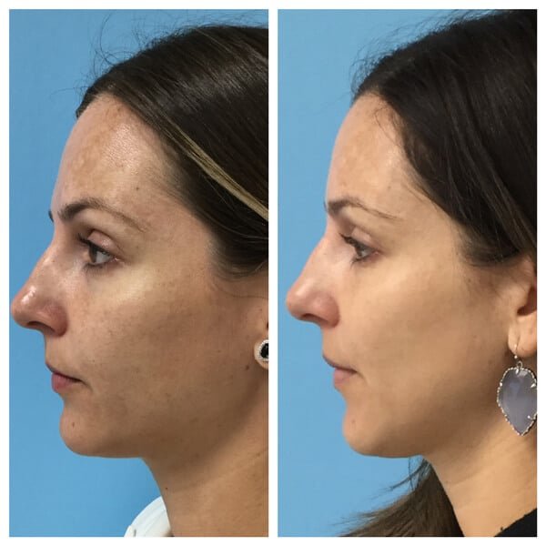IPL photofacial before and after treating sun damage and pigmentation at MedLounge San Ramon using Lumecca IPL