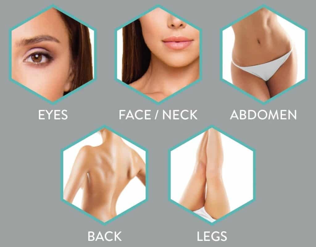 Morpheus8 RF microneedling treatment areas including face, neck, jawline, abdomen, and arms at MedLounge San Ramon