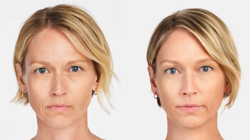 Hyperdilute Radiesse neck tightening before and after results in San Ramon improving skin firmness and texture