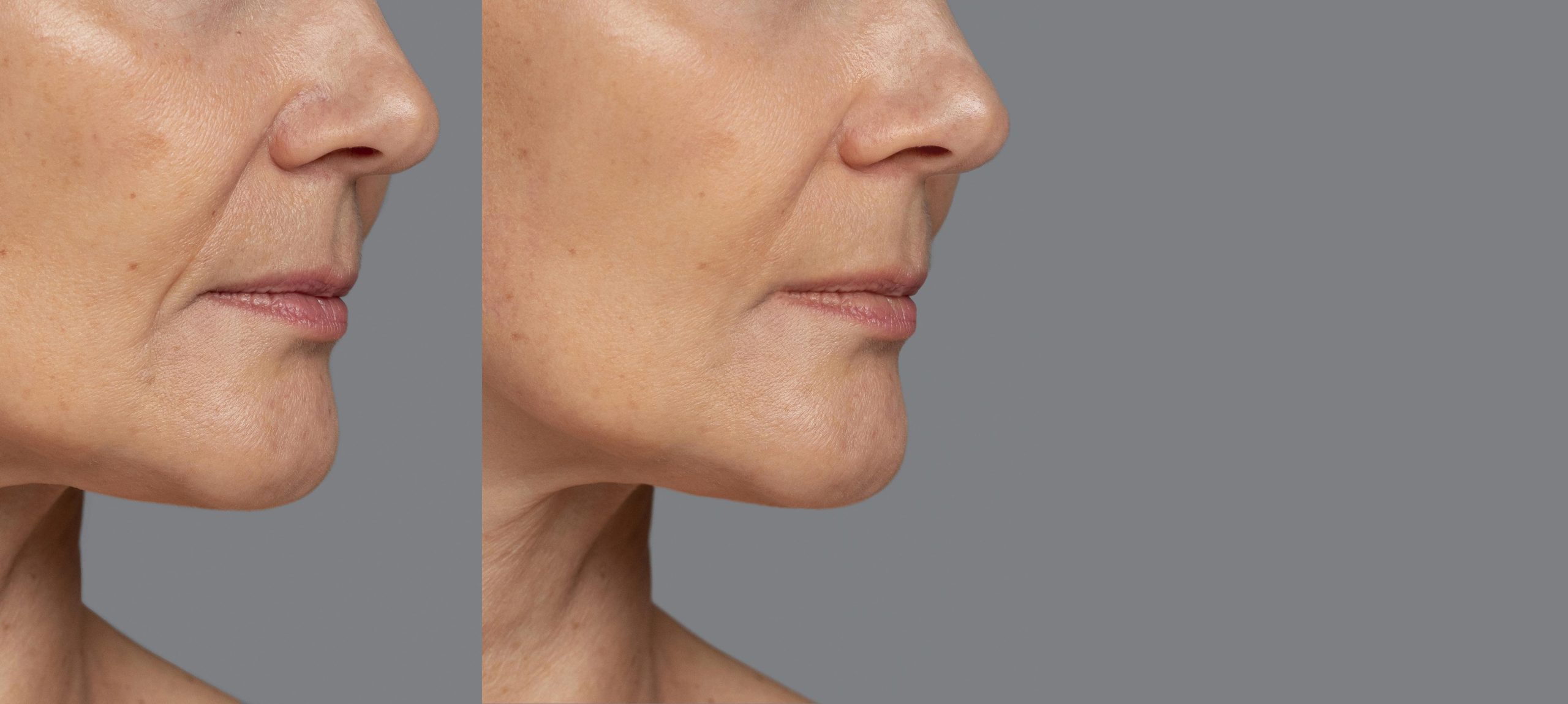 Radiesse jawline contouring before and after results in San Ramon showing improved definition and lower face support