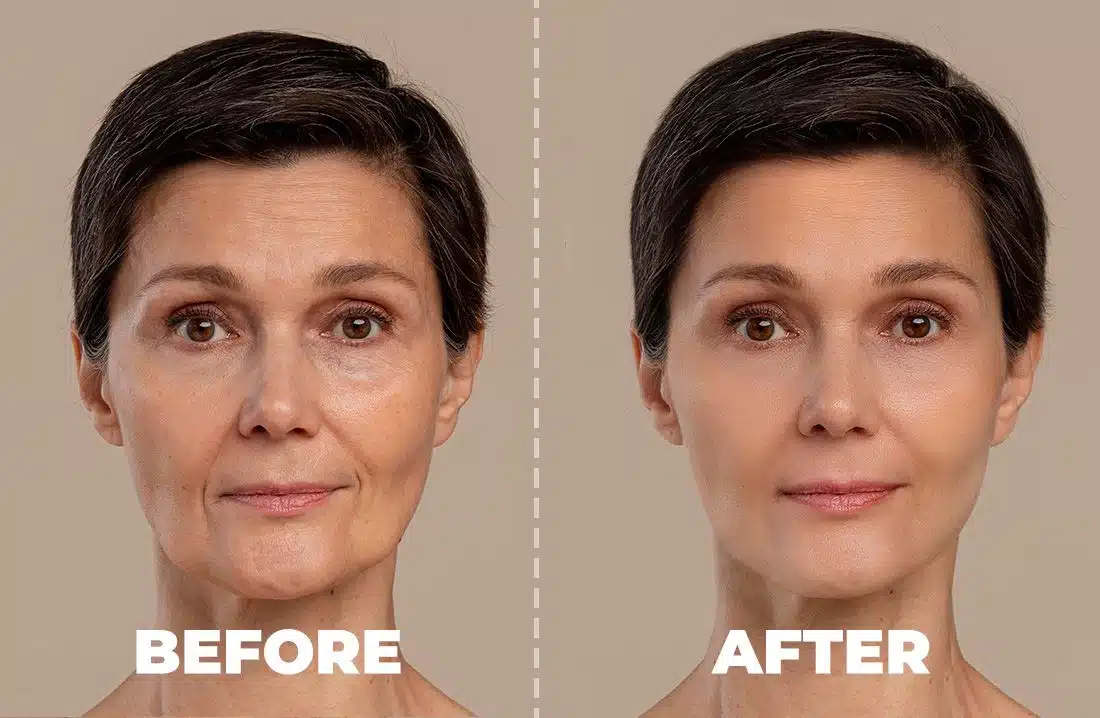 Hydrafacial In San Ramon Ca | Deep Cleansing &Amp; Glowing Skin – Medlounge 8 Radiesse Injections In San Ramon For Collagen Stimulation And Facial Contouring At Medlounge San Ramon