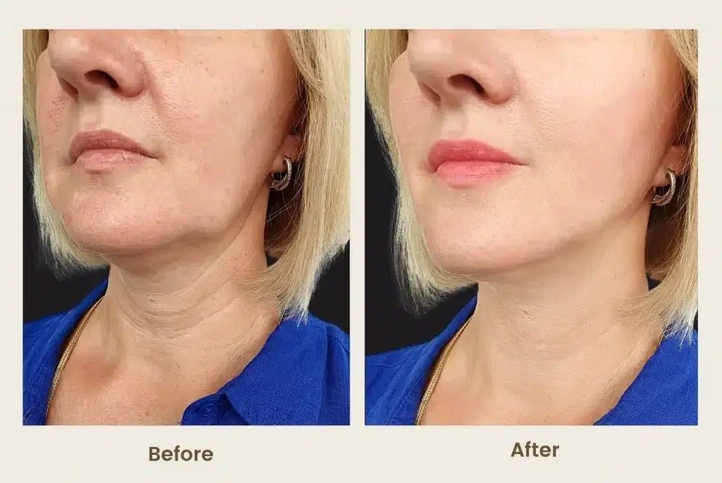 Radiesse chin enhancement before and after results in San Ramon improving profile balance and facial structure